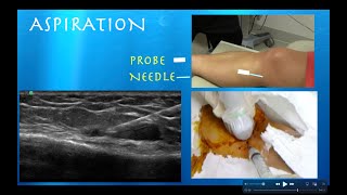 Ultrasound Guided Hoffas Fat Pad AspirationInjection by probeultrasoundcom [upl. by Nihsfa]