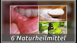 6 Naturheilmittel gegen Aphthen im Mund  Besser Gesund Leben [upl. by Mclyman]