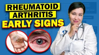 Early Warning Signs Of Rheumatoid Arthritis  Dont Ignore These Vital Symptoms [upl. by Nesmat865]