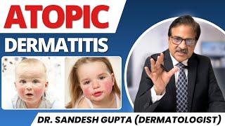 Atopic Dermatitis Kids Allergy  Effective Treatments for Skin Relief [upl. by Bozovich483]