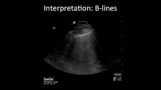 Lung Ultrasound Common Pitfalls [upl. by Flight]