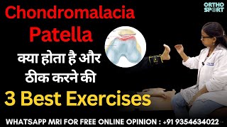 Chondromalacia Patella क्या होता है और ठीक करने की 3 Best Exercises chondromalaciapatella [upl. by Tedie]