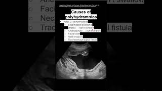 Causes of polyhydramnios [upl. by Ecnedac]