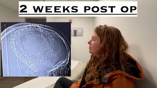 My experience so far 2 weeks after craniotomy surgery for removal of a brain tumor Part 4 [upl. by Yekram]