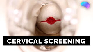 Cervical Screening SMEAR  OSCE Guide  UKMLA  CPSA [upl. by Cryan]