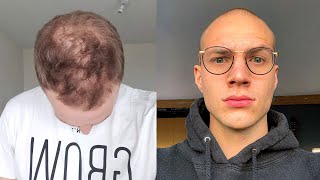 Going Bald In My 20s  Why I Accepted My Hair Loss And Shaved My Head [upl. by Sterner]