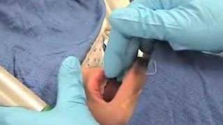 IntubationHow to perform endotracheal intubation  2 [upl. by Cailean595]