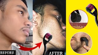 Derma roller for beard  minoxidil beard  derma roller beard growth man matters beard oil review [upl. by Llerraf421]