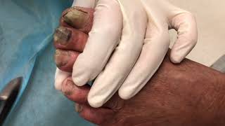 Thick and Painful Fungal Toe Nails  Podiatry Treatment [upl. by Suiravat]