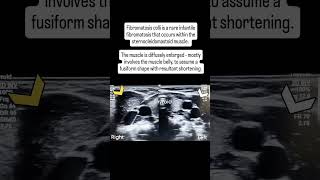 Fibromatosis colli radiology [upl. by Pacien470]