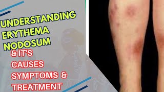 quotUnderstanding Erythema Nodosum Causes Symptoms and Treatmentquot [upl. by Duaner663]