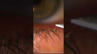 Eyelid Mite Infestation Demodex [upl. by Llert980]