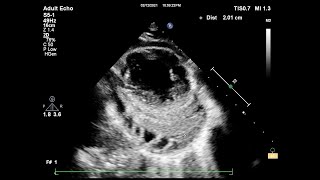 Constrictive pericarditis echocardiography [upl. by Eleirbag]