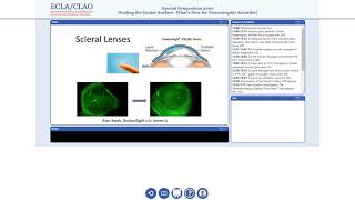 Neurotrophic Keratitis [upl. by Ahseniuq]