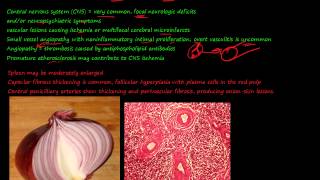 92P Morphology of Systemic lupus erythematosus SLE part 3 [upl. by Ynez987]