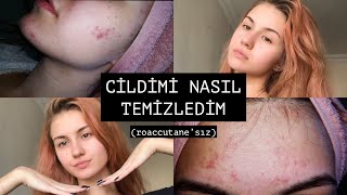 SİVİLCELERİMDEN NASIL KURTULDUM ✨ roaccutane’sız [upl. by Tiga971]