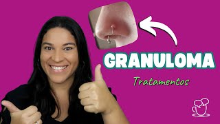 Granuloma PÓS PIERCING o que é e como tratar [upl. by Aleyam]