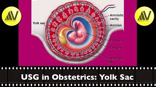 USG in Obstetrics Yolk sac [upl. by Eillit]