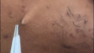 INGROWN HAIR REMOVAL 67  Plucking my chin BALD… again 😼 [upl. by Lemar]