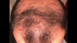 6 months using minoxidil  Rogaine 5 Before amp After results [upl. by Rengia189]