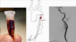 Thrombectomy in acute stroke – can we extend the time window [upl. by Yeleen]