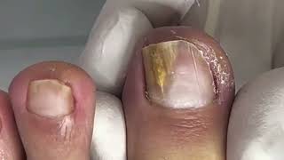 Removing Toenail Fungus FAST [upl. by Riggall764]