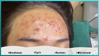 Big Cystic Acne Blackheads Extraction Blackheads amp Milia Whiteheads Removal Pimple Popping [upl. by Eitteb]