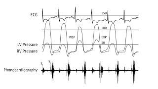 Pericardial Knock in Constrictive Pericarditis [upl. by Koslo686]