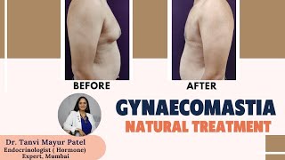 Gynaecomastia Natural Treatment  Gynecomastia Treatment Without Surgery  Dr Tanvi Mayur Patel [upl. by Floria]