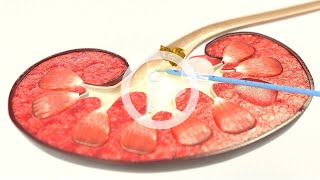 UROMED Balloon Catheter Set NEPHROquick®  Percutaneous nephrostomy catheter for renal drainage [upl. by Eeliah]