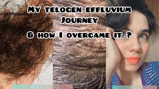 I was bald after dengue fever  Understanding telogen effluvium telogeneffluviumrecovery [upl. by Lindley]