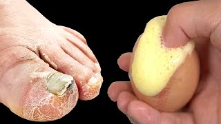 Cure Toenail Fungus For Less Than 1 in under 1 minute You must do it [upl. by Ocinom690]