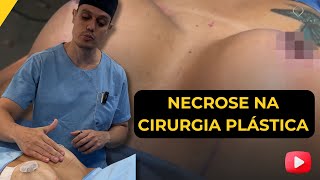 NECROSE NA CIRURGIA PLASTICA [upl. by Aara]