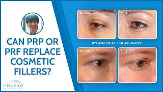 Why PRP or PRF Cannot Replace Dermal Fillers [upl. by Phillipp627]