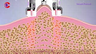 How Vacuum RF Fat Reduction Skin Tightening Treatment WorkSlimming Lymphatic Drainage Machine [upl. by Saxe767]