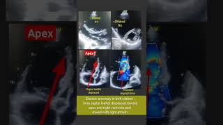 2D Echo of Ebstein anomaly l Tricuspid valve echotest shorts [upl. by Adla]