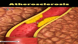 Atherosclerosis  What is atherosclerosis Heart attack  The real reason healthtips heartattack [upl. by Nuncia]