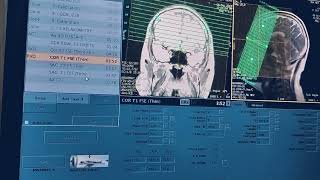 MRI CSF rhinorrhea or CSF cisternogram planning and sequence will full detailed explanation [upl. by Pascal97]