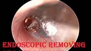 Treasure Hunt in Ear  Searching amp Removing Lost Diamond Endoscopic [upl. by Mcferren]