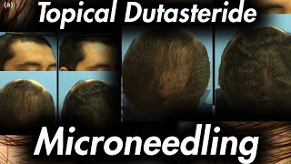 Microneedling and Topical Dutasteride [upl. by Neeneg]