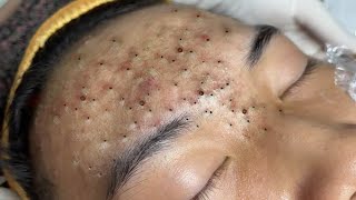 Big Cystic Acne Blackheads Extraction Blackheads amp Milia Whiteheads Removal Pimple Popping  316 [upl. by Eirolav]