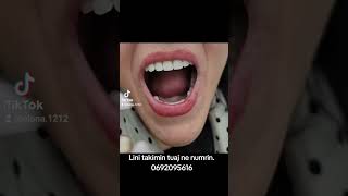 PROTEZA ANTIALERGJIKEgoviral fypage dentist smile dentalclinic cosmeticdentistry goviral [upl. by Hannie917]