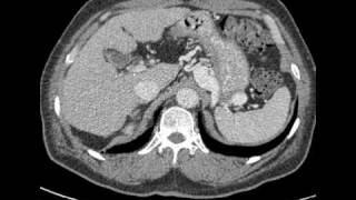 CT interpretation  portorenal shunt in cirrhotic patient [upl. by Seditsira]