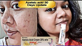 How to Use Retinol amp Azelaic Acid Together  Skin A and Skinoren Cream [upl. by Longerich346]