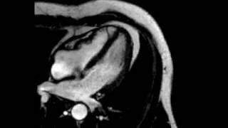 Constrictive pericarditis fourchamber ECGgated cine SSFP MR [upl. by Infield218]