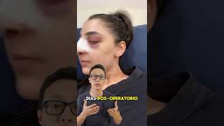 Rinoplastia deu certo [upl. by Nodarb]