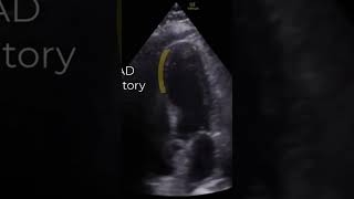 Middistal septal wall motion abnormality LAD ischemia Annotated pocus foamed echofirst echo [upl. by Aremat728]