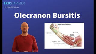 Olecranon Bursitis [upl. by Noyahs406]