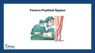 FemoroPopliteal Bypass [upl. by Ecirbaf182]