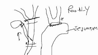 Gallbladder Removal Common Bile Duct Injuries [upl. by Hallerson]